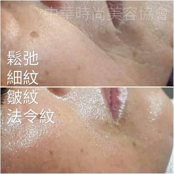 韓國MTS健康皮膚管理