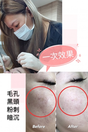 韓國MTS健康皮膚管理