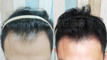 SMP頭皮紋髮